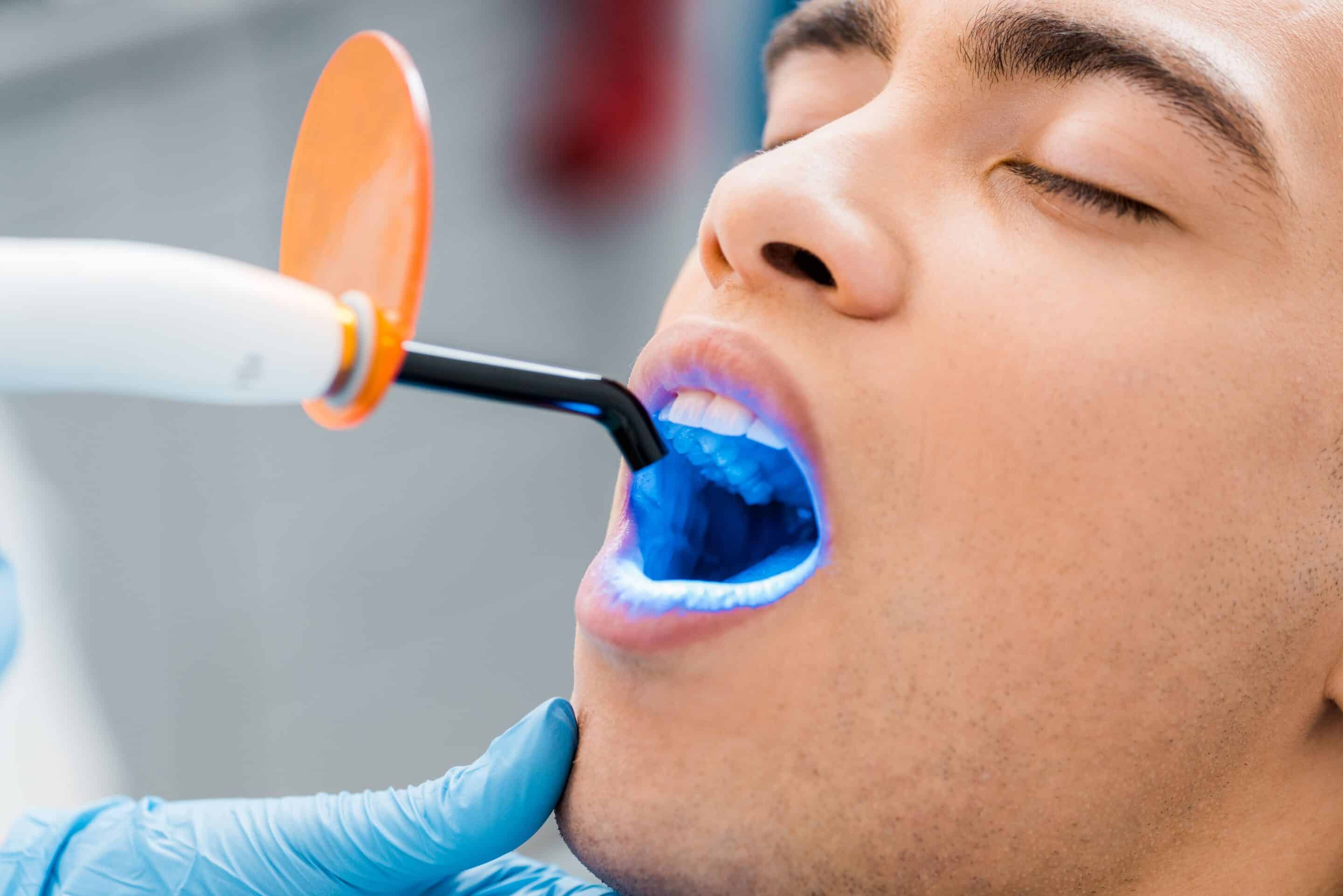 Zahnbleaching Methoden, Kosten und Tipps für strahlend weiße Zähne